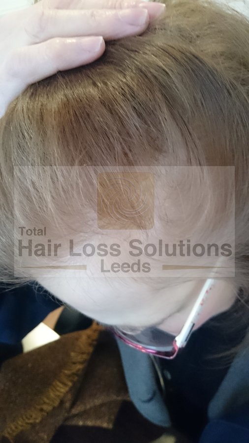 Total Hair Loss Solutions - Total Hair Loss Solutions