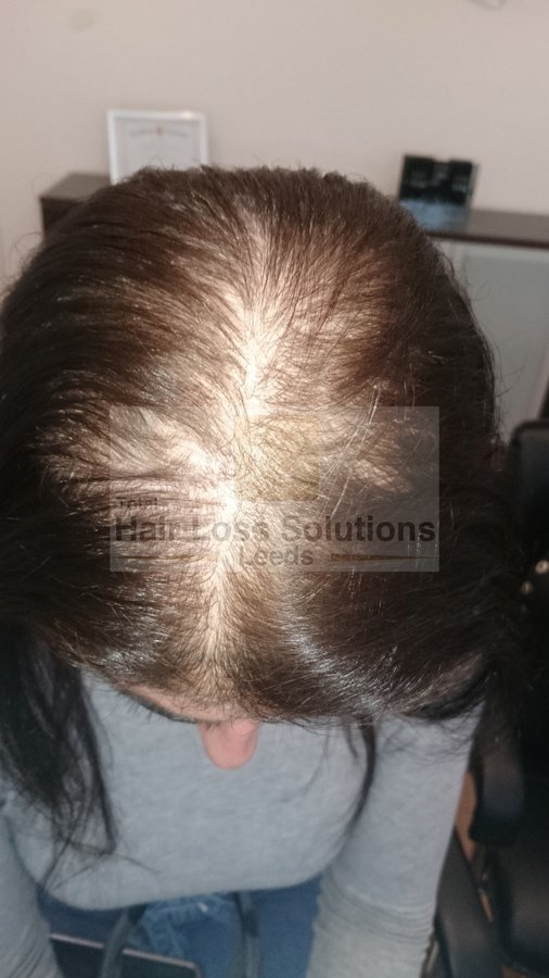 Total Hair Loss Solutions - Total Hair Loss Solutions