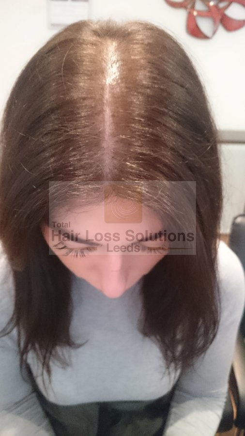 Total Hair Loss Solutions - Total Hair Loss Solutions