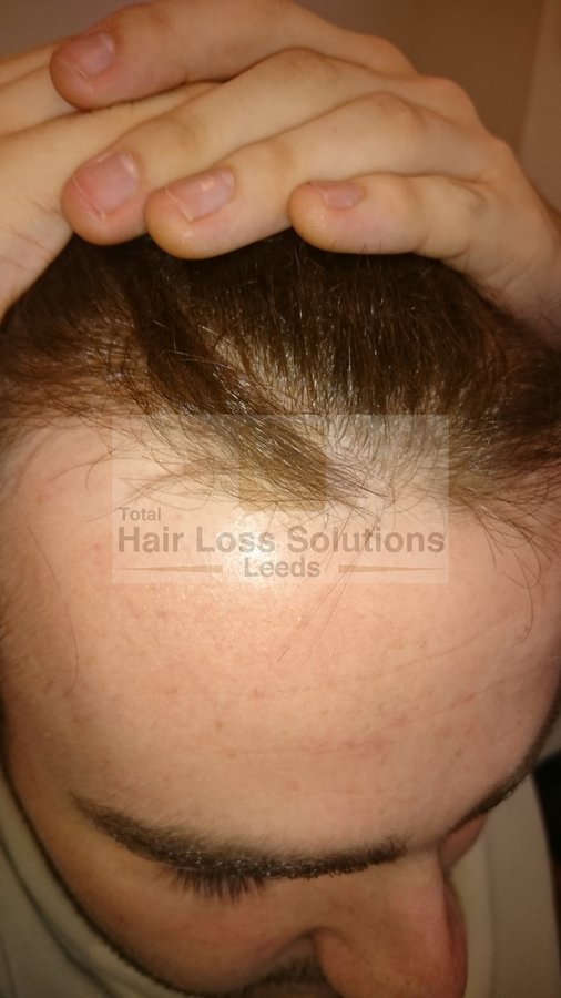 Total Hair Loss Solutions - Total Hair Loss Solutions