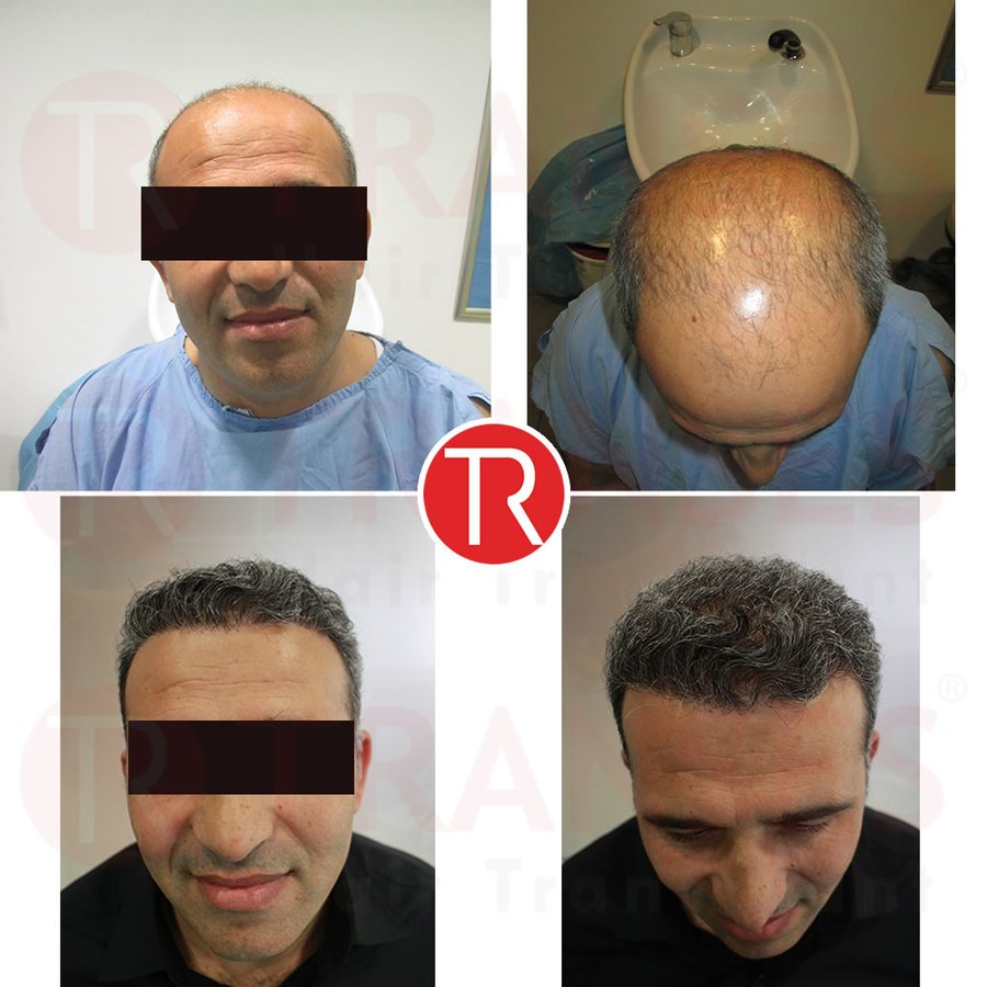 Transes Hair Transplant - Transes Hair Transplant