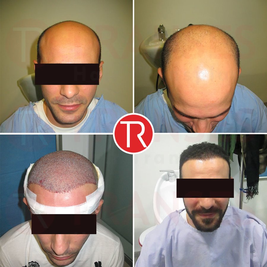 Transes Hair Transplant - Transes Hair Transplant