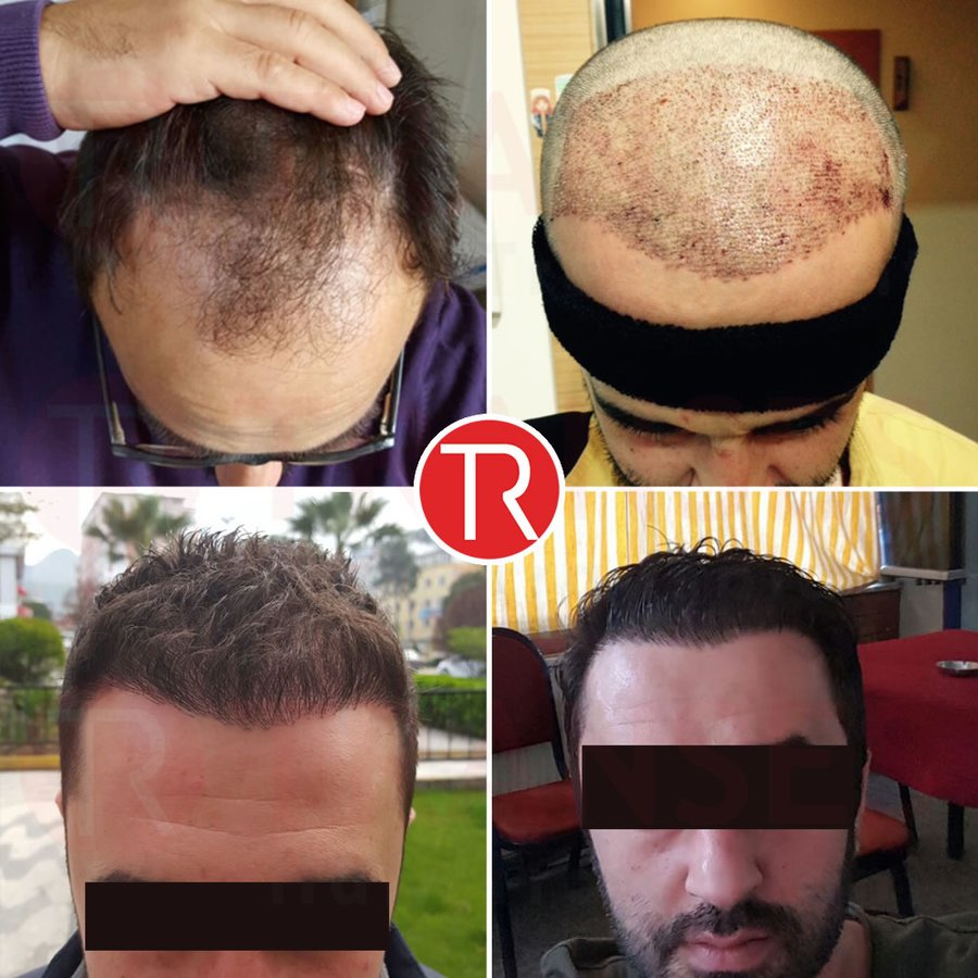 Transes Hair Transplant - Transes Hair Transplant