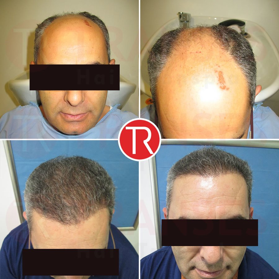 Transes Hair Transplant - Transes Hair Transplant