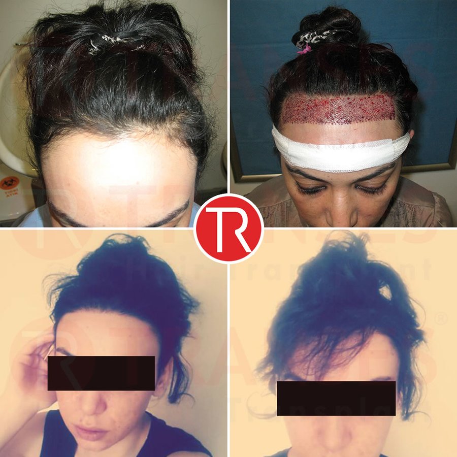Transes Hair Transplant - Transes Hair Transplant