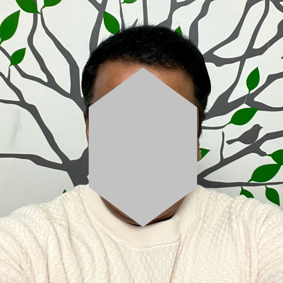 Transes Hair Transplant - Transes Hair Transplant