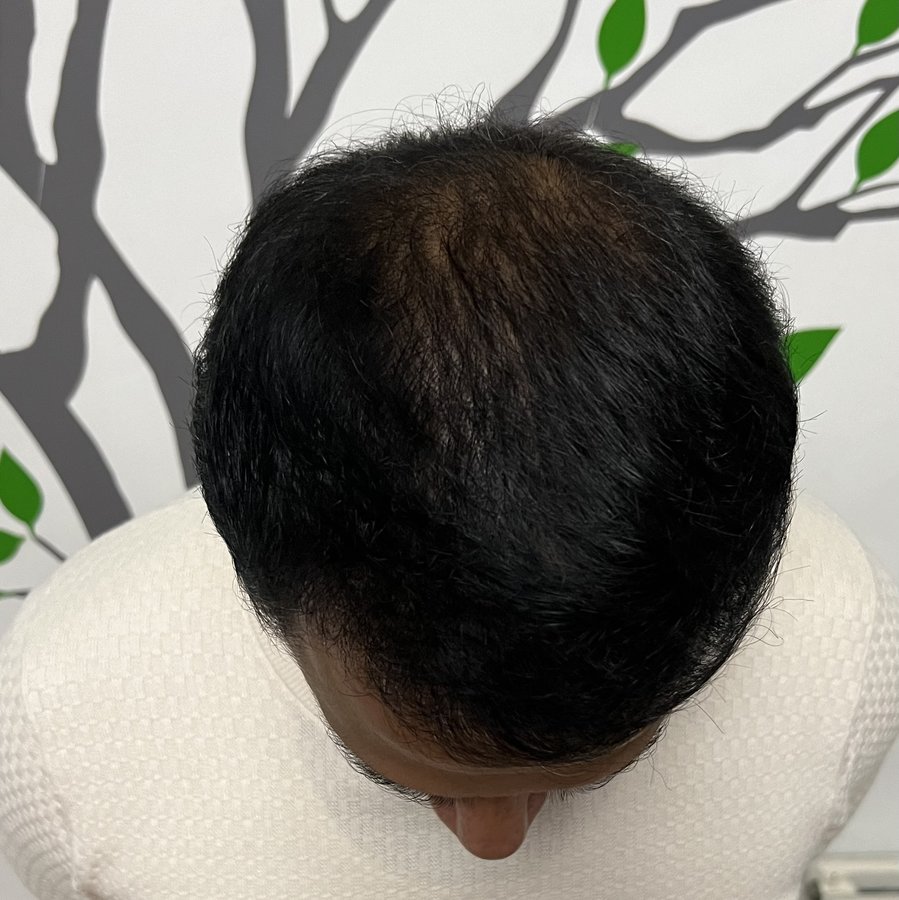 Transes Hair Transplant - Transes Hair Transplant