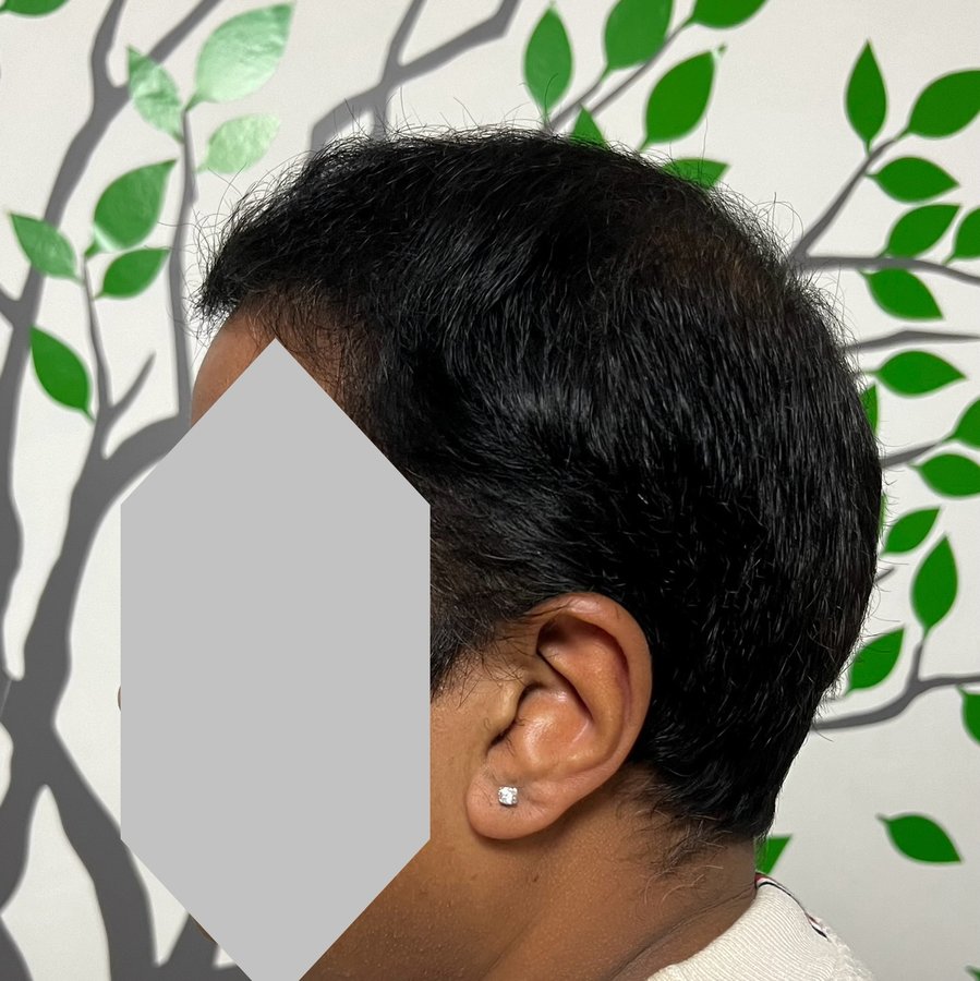 Transes Hair Transplant - Transes Hair Transplant