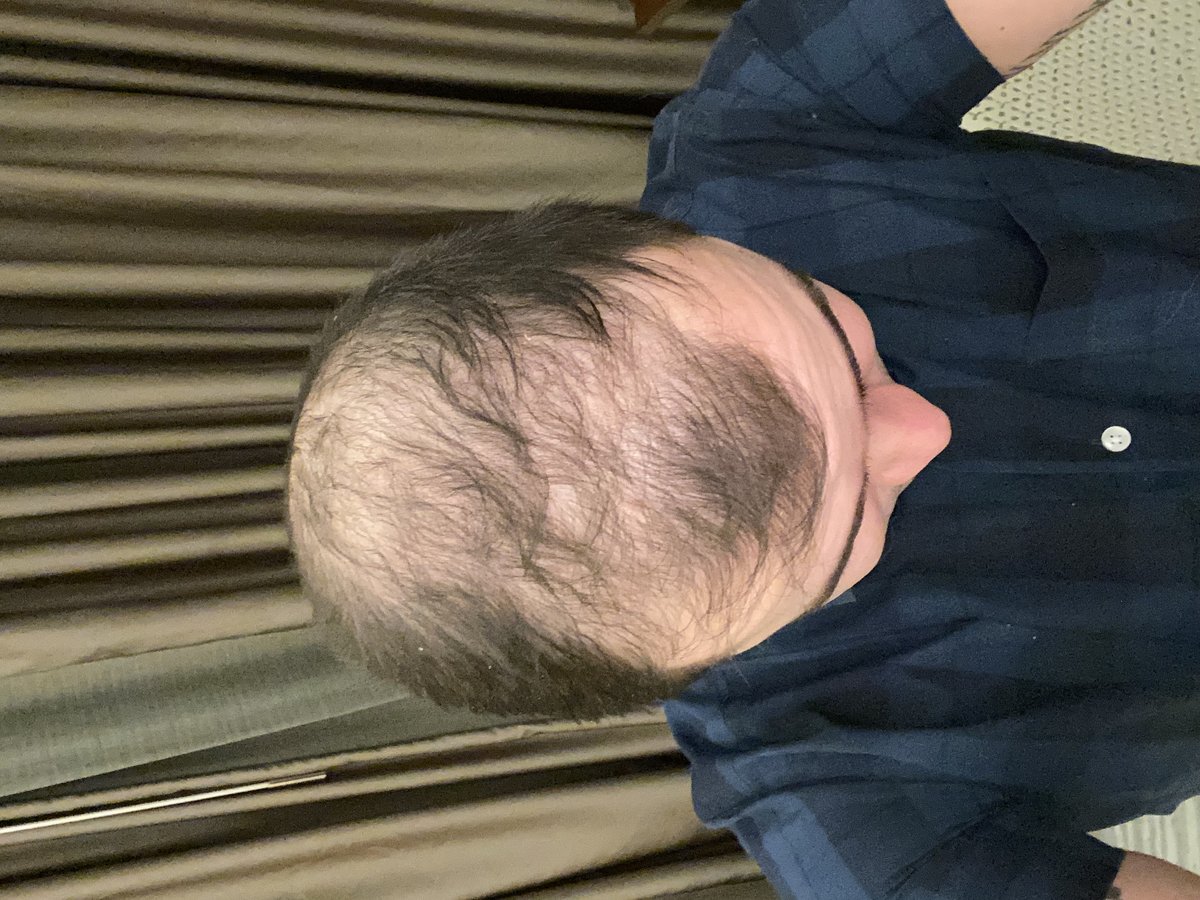 Transes Hair Transplant - Transes Hair Transplant