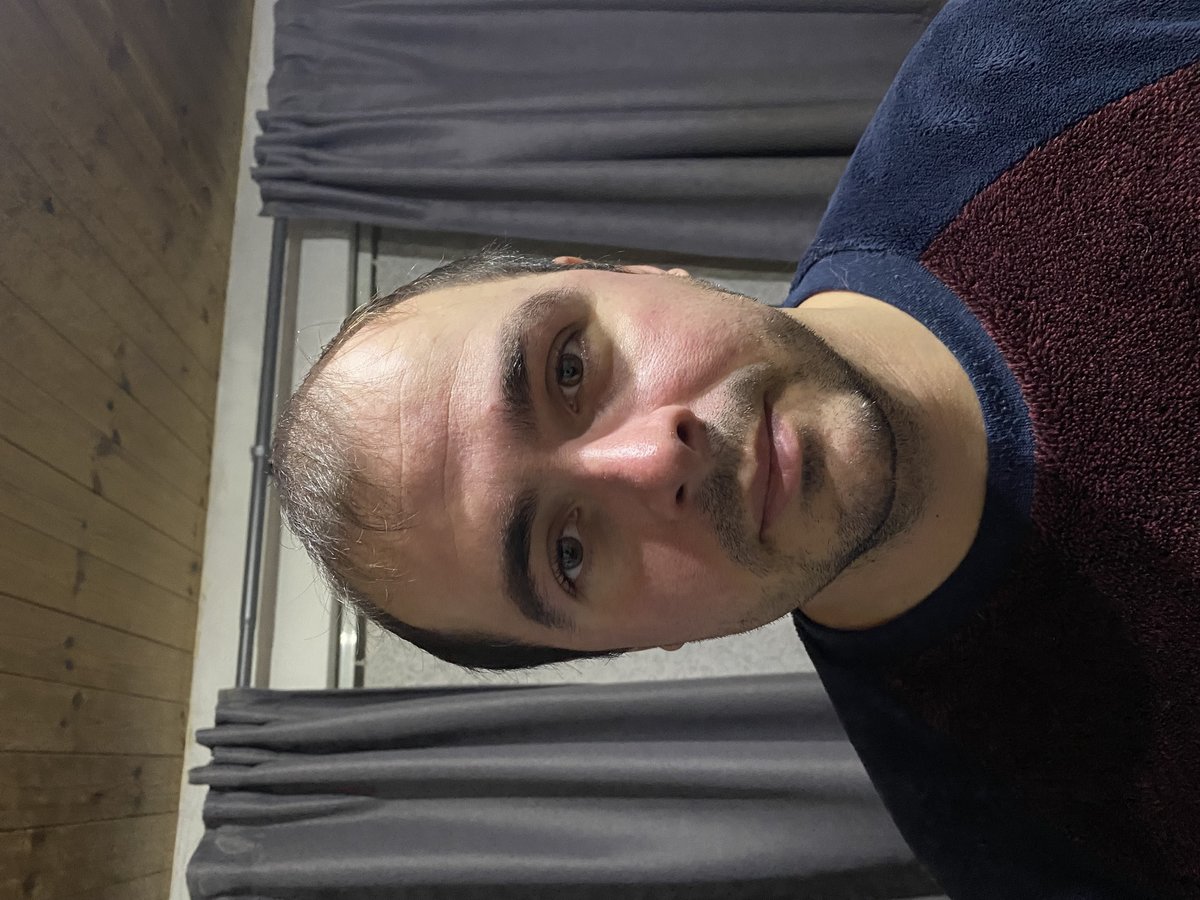 Transes Hair Transplant - Transes Hair Transplant