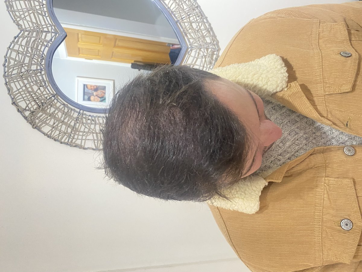 Transes Hair Transplant - Transes Hair Transplant