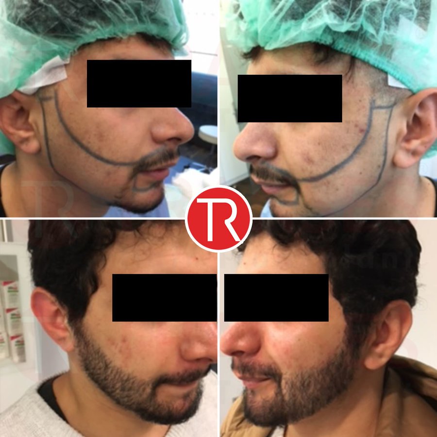 Transes Hair Transplant - Transes Hair Transplant