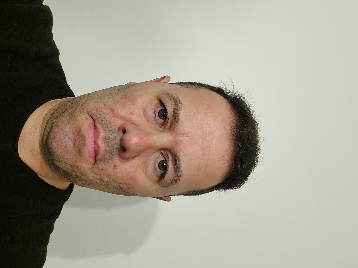 Transes Hair Transplant - Transes Hair Transplant