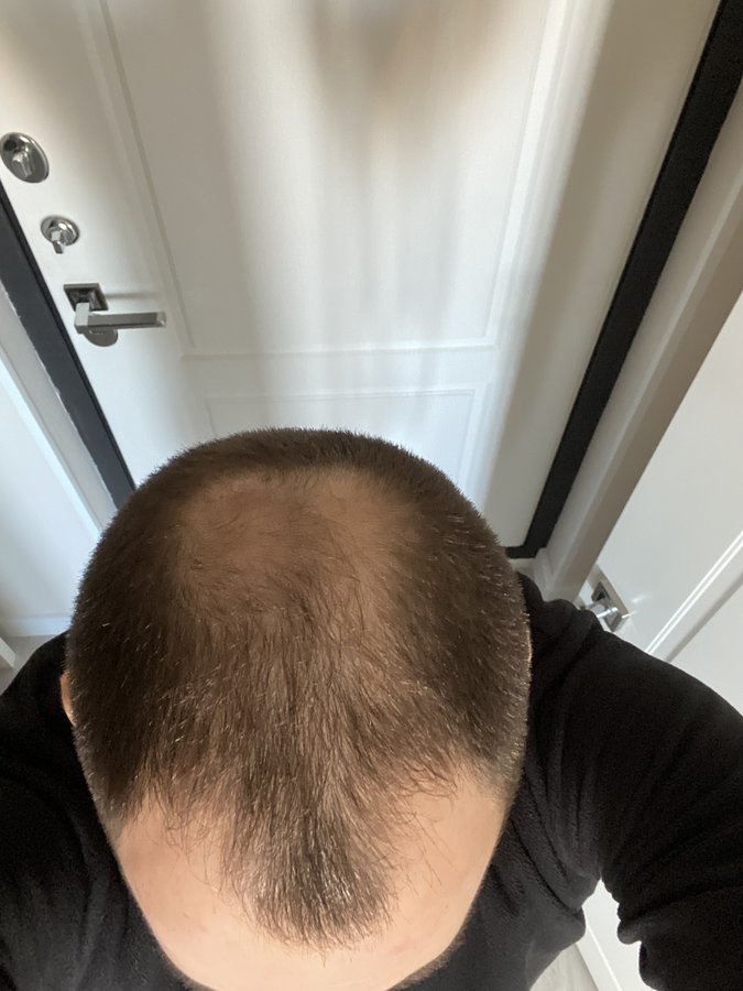 Transes Hair Transplant - Transes Hair Transplant