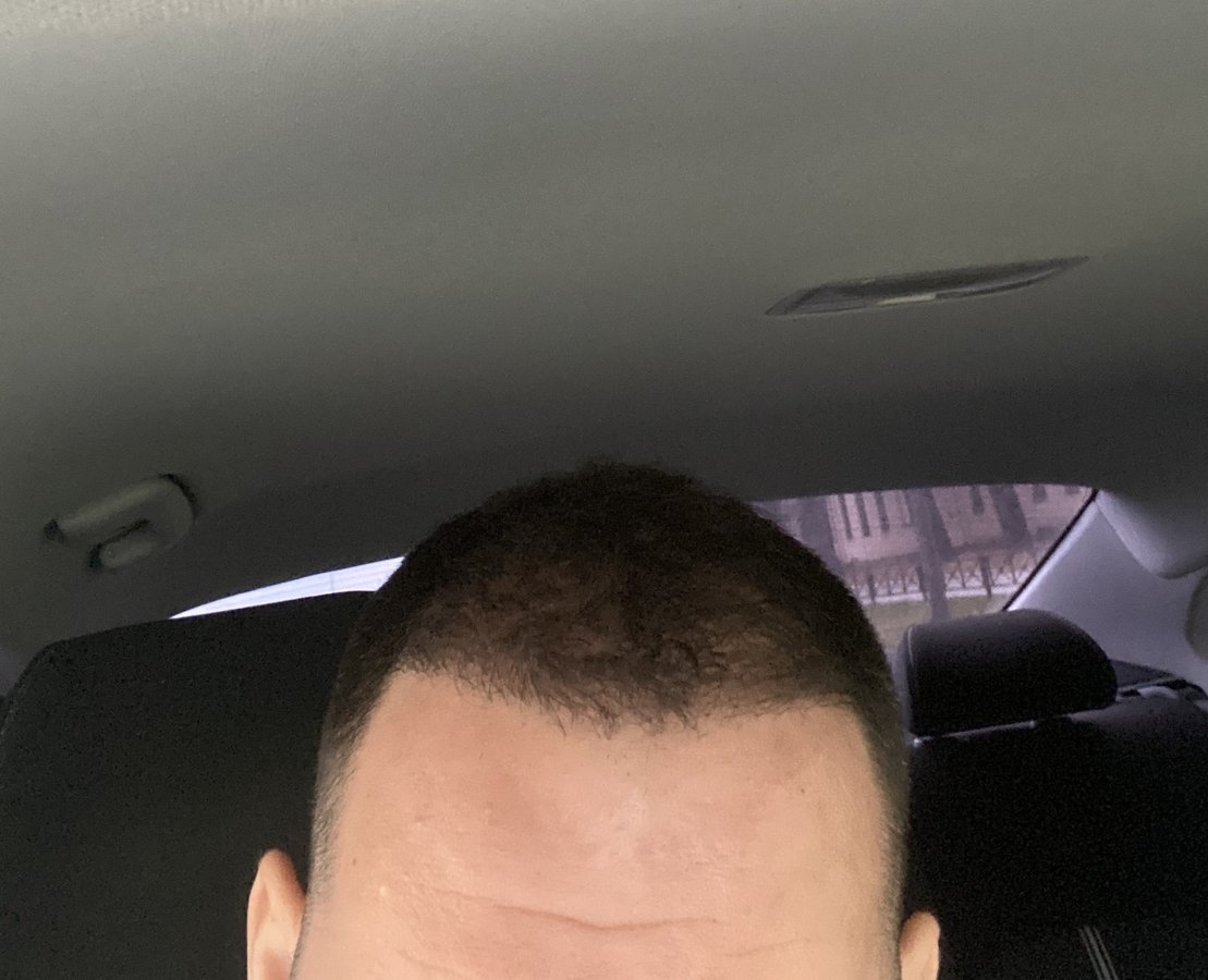 Transes Hair Transplant - Transes Hair Transplant