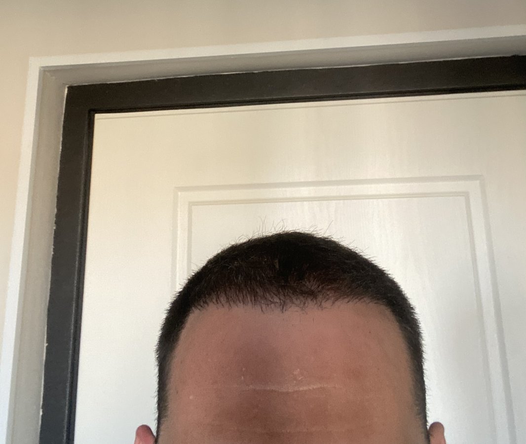 Transes Hair Transplant - Transes Hair Transplant