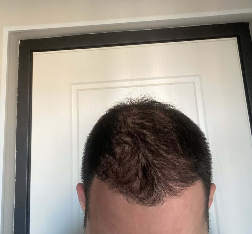 Transes Hair Transplant - Transes Hair Transplant