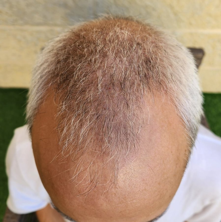 Transes Hair Transplant - Transes Hair Transplant