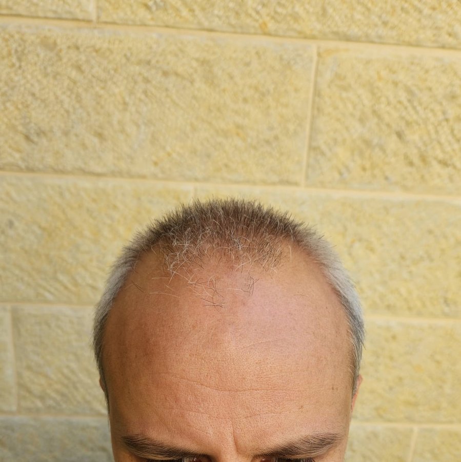 Transes Hair Transplant - Transes Hair Transplant