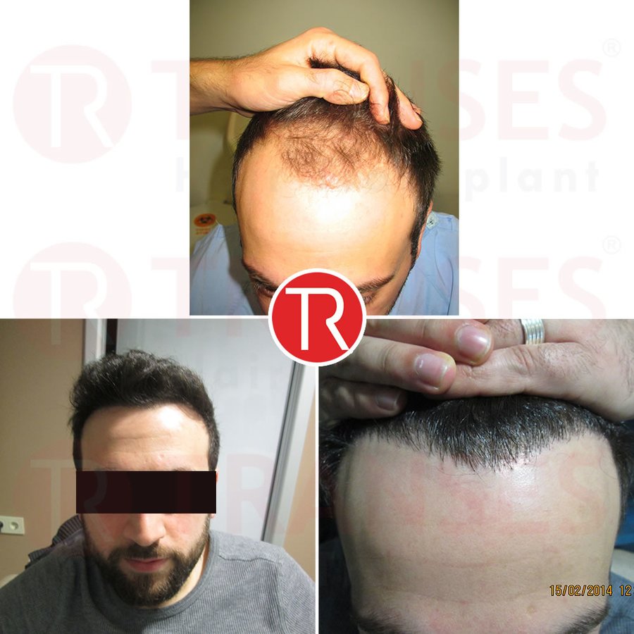 Transes Hair Transplant - Transes Hair Transplant