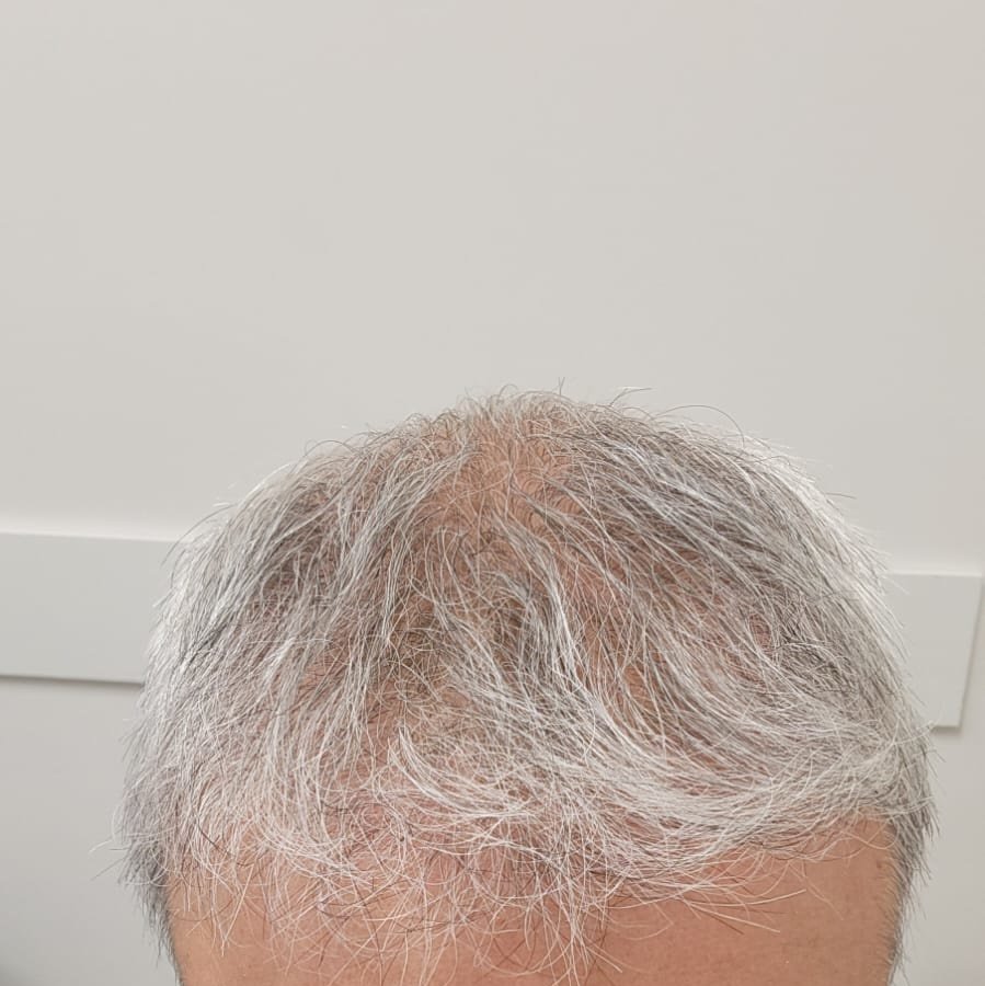 Transes Hair Transplant - Transes Hair Transplant