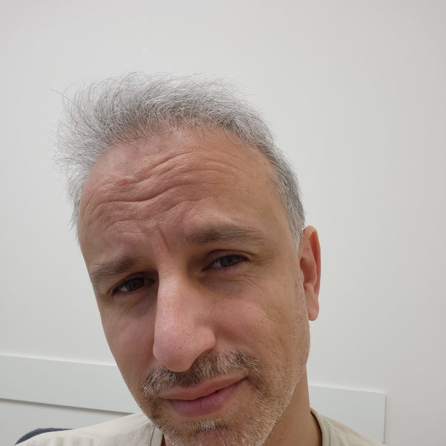 Transes Hair Transplant - Transes Hair Transplant