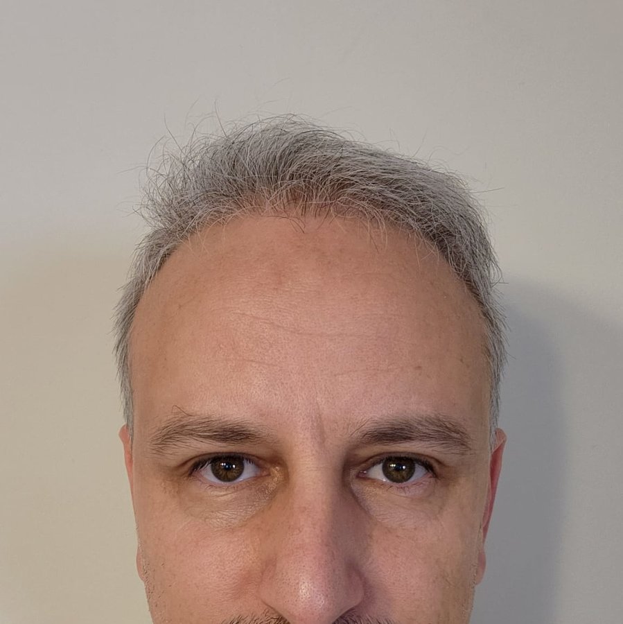 Transes Hair Transplant - Transes Hair Transplant