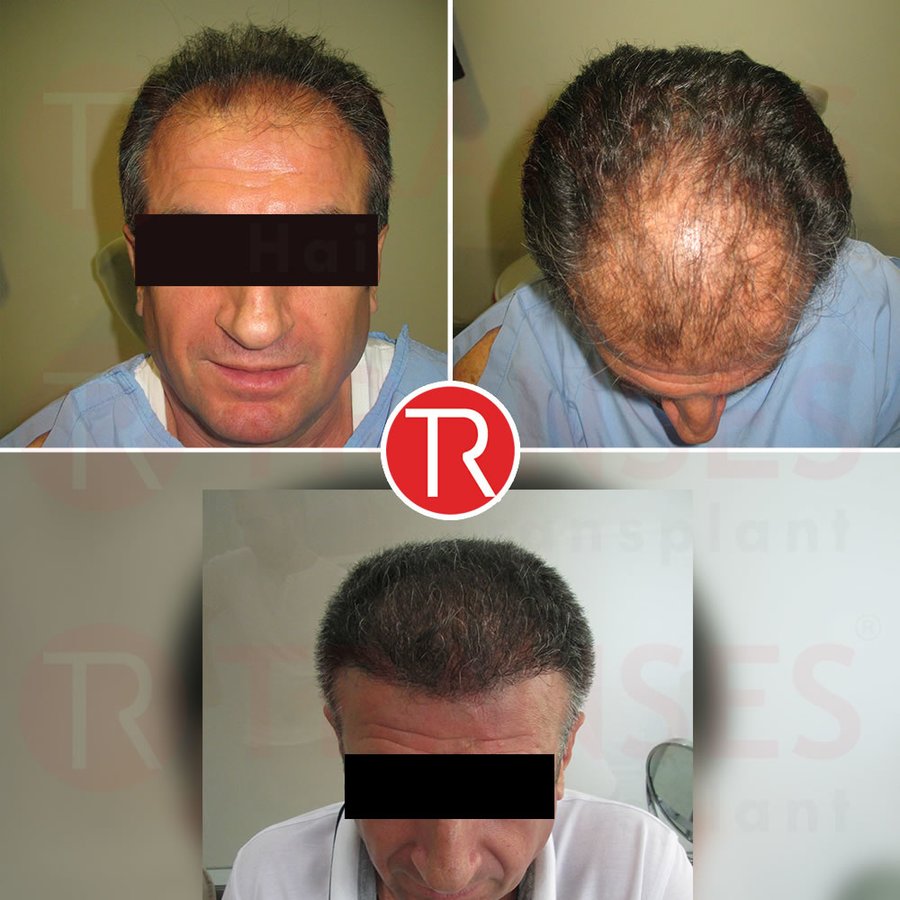 Transes Hair Transplant - Transes Hair Transplant