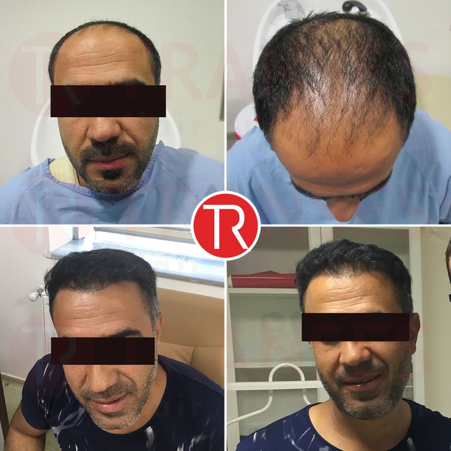 Transes Hair Transplant - Transes Hair Transplant