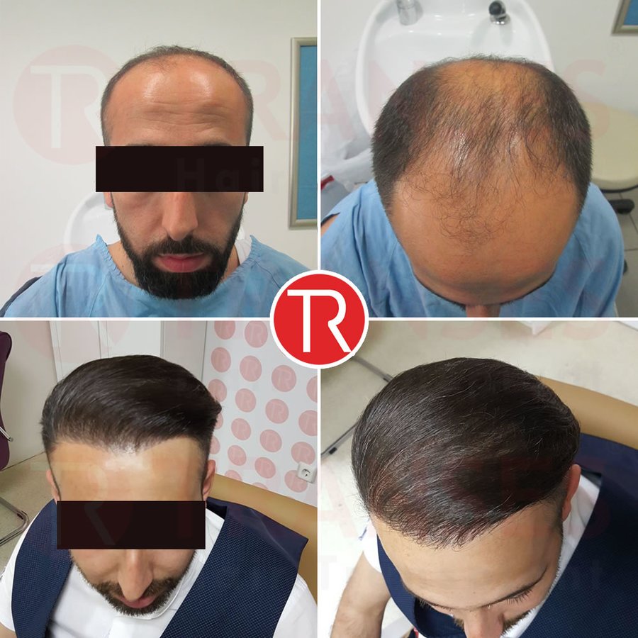 Transes Hair Transplant - Transes Hair Transplant