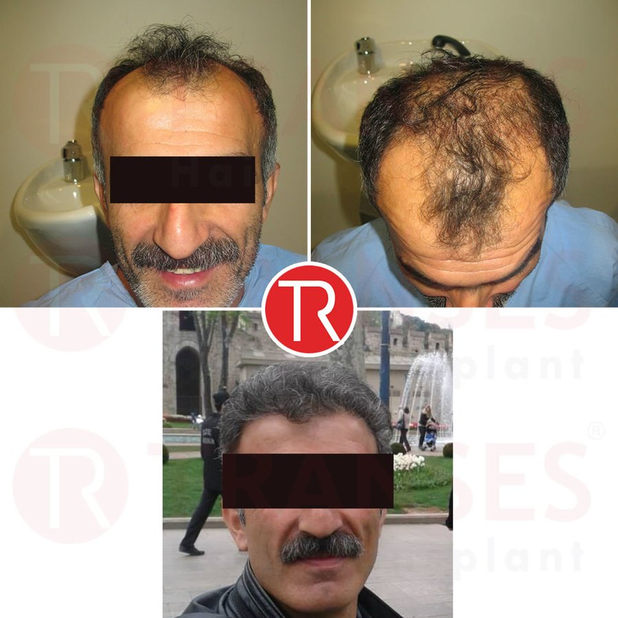 Transes Hair Transplant - Transes Hair Transplant