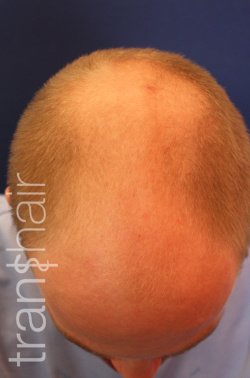 Transhair Hair Clinic - Transhair Hair Clinic