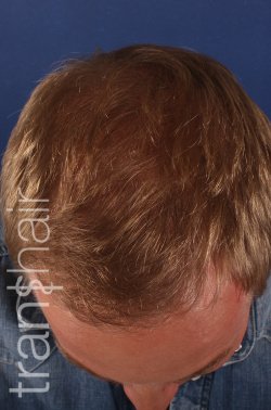 Transhair Hair Clinic - Transhair Hair Clinic