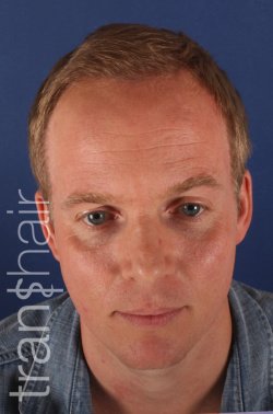 Transhair Hair Clinic - Transhair Hair Clinic