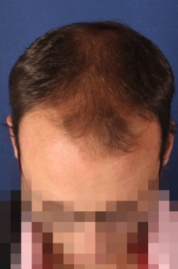 Transhair Hair Clinic - Transhair Hair Clinic