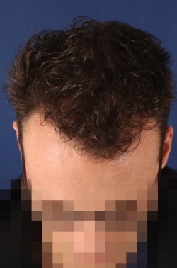 Transhair Hair Clinic - Transhair Hair Clinic