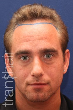 Transhair Hair Clinic - Transhair Hair Clinic