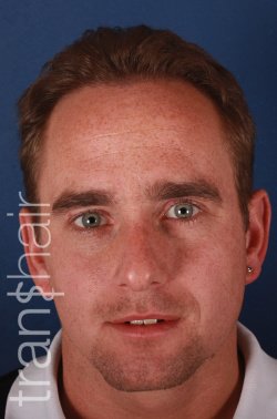 Transhair Hair Clinic - Transhair Hair Clinic