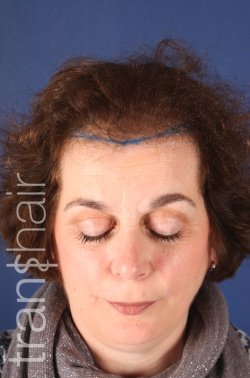 Transhair Hair Clinic - Transhair Hair Clinic