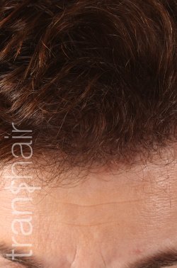 Transhair Hair Clinic - Transhair Hair Clinic