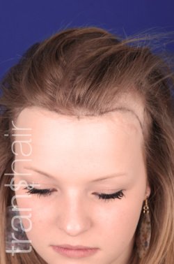 Transhair Hair Clinic - Transhair Hair Clinic