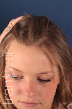 Transhair Hair Clinic - Transhair Hair Clinic