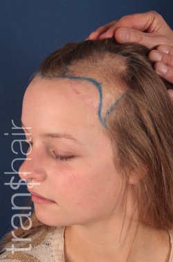 Transhair Hair Clinic - Transhair Hair Clinic