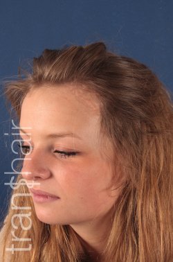 Transhair Hair Clinic - Transhair Hair Clinic