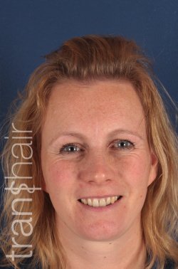 Transhair Hair Clinic - Transhair Hair Clinic