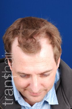 Transhair Hair Clinic - Transhair Hair Clinic