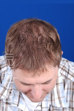 Transhair Hair Clinic - Transhair Hair Clinic