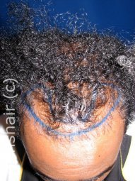 Transhair Hair Clinic - Transhair Hair Clinic