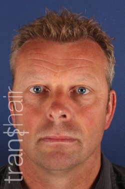 Transhair Hair Clinic - Transhair Hair Clinic