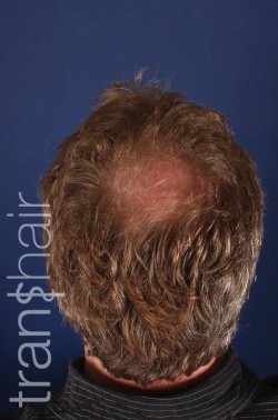 Transhair Hair Clinic - Transhair Hair Clinic